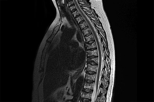 Manifestacións da osteocondrose torácica á imaxe da resonancia magnética