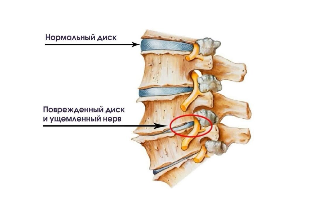 Síntomas da osteocondrose cervical