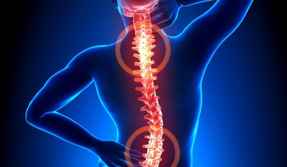 osteocondrose espinal