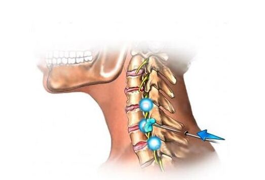 tratamento da osteocondrose cervical